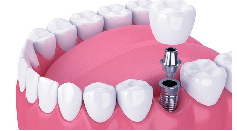 Dental Implants